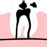 Tooth Decay